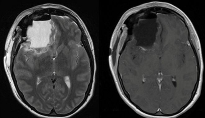 Peste 100 de absolvenți ai aceluiași liceu au făcut o formă rară de cancer cerebral. Ce arată ancheta - yxnopti0njg3mdfjzgeznme4n2y3ndyx-1653907169.jpg