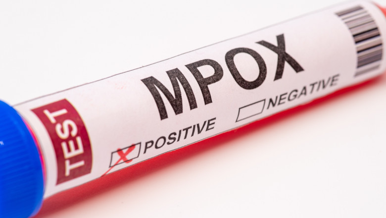 Marea Britanie anunţă primul caz de infectare cu noua variantă de mpox - ztdhyzuxyja0nwu3odixodq0zjqwmjgw-1730312955.jpg