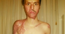 Stire din Eveniment : Un tânăr ars în Colectiv își acuză mama: "I-a luat concubinului mașină cu banii din donații! Intru în greva foamei"