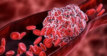 Stire din Social : STUDIU AJUNS LA FINAL. Creşte riscul de cheaguri sangvine în primele şase luni după infectarea cu Covid