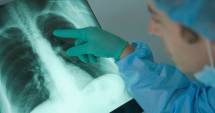Stire din Sănătate : Analize GRATUITE pentru depistarea cancerului pulmonar