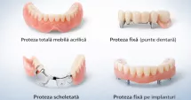 Stire din Social : Tipuri de proteze dentare: care este soluția potrivită pentru tine?