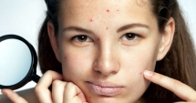 Cum să scapi de acnee definitiv. Sfaturi de la specialist
