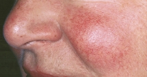 Cum se manifestă acneea rozacee