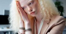 Stire din Sănătate : Persoanele cu albinism au, de cele mai multe ori, probleme cu vederea