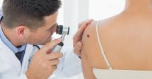 Stire din Social : Medicii avertizează: A crescut numărul cazurilor de melanom