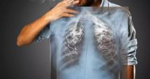 Stire din Sănătate : Beatrice Mahler: 694 de cazuri de cancer pulmonar diagnosticate în primele şase luni ale anului - peste 61% cu metastaze