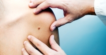 Stire din Sănătate : Pericolul expunerii la soare! Favorizează apariția cancerului de piele