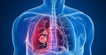 Stire din Actualitate : Creşterea cazurilor de cancer pulmonar la nefumători, legată de un gaz radioactiv din aer