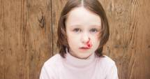 Stire din Sănătate : Care este cauza sângerărilor nazale