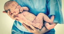 Stire din Sănătate : DIN NOU ÎN ALERTĂ! A crescut numărul cazurilor de rujeolă