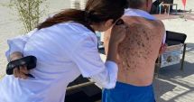 Stire din Social : Consultații dermatologice gratuite la mare pentru depistarea cancerului de piele