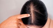 Stire din Sănătate : Aveți coji pe scalp? Iată ce poate însemna acest lucru