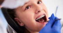 Stire din Actualitate : "Nu-mi pun aparat dentar. O să râdă toţi de mine!" - Cum îţi ajuţi copilul cu dinţi încălecaţi?