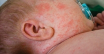 Stire din Sănătate : Epidemie de rujeolă!  Au murit deja șase persoane