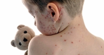 Focar de varicelă la Constanța! Copiii de grădiniță, cei mai expuși