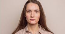 Stire din Sănătate : Acneea la adolescenți: de ce tratamentele găsite pe rețelele sociale pot fi periculoase