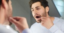 Stire din Sănătate : Probleme ce duc la apariţia petelor şi veziculelor la nivelul gingiilor