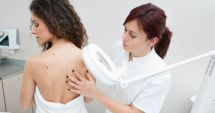 Stire din Sănătate : Alunițe prea multe? Feriți-le pe cât puteți de razele solare!