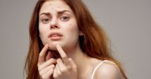 Stire din Sănătate : De la acnee la anxietate. Ce ne spune pielea despre sănătatea mintală