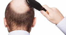 Stire din Sănătate : Cum poate fi stopată căderea părului. "Nu există un tratament standard pentru alopecie"