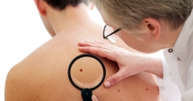 Stire din Sănătate : Analiza care diagnostichează cu precizie cancerul de piele