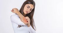 Stire din Sănătate : Urticaria se poate ameliora şi cu ajutorul tratamentelor naturiste