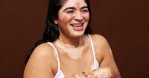 Stire din Sănătate : Nu vă speriaţi! Vitiligo nu este o boală contagioasă