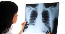 Stire din Sănătate : Investigații gratuite pentru depistarea cancerului pulmonar