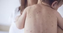 Stire din Social : Copil mort de rujeolă, frații săi - în spital. Niciunul nu e vaccinat