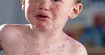 Stire din Sănătate : EPIDEMIE DE RUJEOLĂ / Vești bune pentru părinți, de la ministrul Sănătății