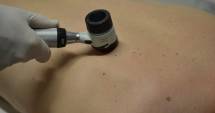 Stire din Sănătate : Mergeți la medic cu alunițele! Cancerul de piele poate fi vindecat