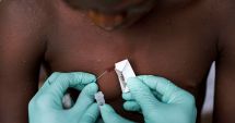 Stire din Actualitate : O boală nouă, extrem de contagioasă, face ravagii în SUA