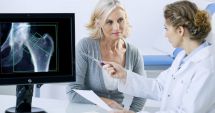 Stire din Sănătate : Ce alimente pot preveni instalarea precoce a osteoporozei
