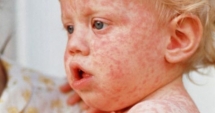 Stire din Social : Un nou deces cauzat de rujeolă: Copilul nu era vaccinat!