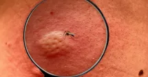 Stire din Actualitate : Alertă sanitară! România confirmă primul pacient cu virusul Chikungunya