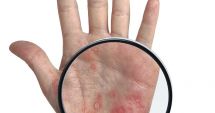 Stire din Sănătate : Stresul agravează simptomele psoriazisului şi creşte riscul de recidivă