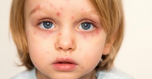 Stire din Sănătate : Epidemia de rujeolă este de neoprit. 24 de cazuri noi numai în ultima săptămână