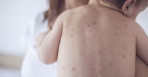 Stire din Sănătate : E JALE! INCĂ UN COPIL NAVACCINAT, UCIS DE RUJEOLĂ