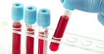 Cancerul ovarian ar putea fi detectat printr-un test de sânge