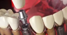 Stire din Actualitate : Bărbat găsit mort după depresie severă provocată de un tratament dentar eșuat în străinătate