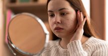 Stire din Sănătate : Excesul de sebum duce la probleme cu pielea, acnee și pori blocați
