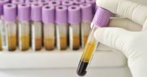 Stire din Sănătate : Testul pentru hepatită. Află dacă ai un ficat bolnav