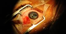 Un bărbat și-a recuperat vederea după un transplant de cornee de la porc
