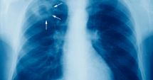 Tuberculoza poate fi transmisă printr-o simplă respirație