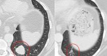 Stire din Sănătate : CEA MAI IMPORTANTĂ DESCOPERIRE DUPĂ CHIMIOTERAPIE! Imunoterapia a tratat cele mai agresive forme de cancer