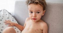 Stire din Sănătate : De ce nu este indicat să ieșiți din casă dacă aveți varicelă