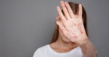 Stire din Sănătate : Virusul varicelei se poate reactiva la maturitate