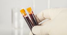 Stire din Social : Peste 800 de pacienți HIV-pozitivi testați pentru boli hepatice, într-un proiect-pilot la Constanța