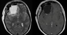 Stire din Actualitate : Peste 100 de absolvenți ai aceluiași liceu au făcut o formă rară de cancer cerebral. Ce arată ancheta